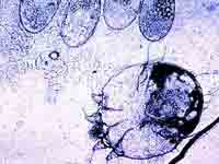 scabies mite